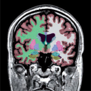 Segmentación de las distintas estructuras cerebrales de un sujeto normal. Corteza (rojizo), sustancia blanca (derecha: verde, izquierda: blanca), ganglios basales, hipocampos (verde) y amígdalas (celeste). Software Freesurfer (http://ftp.nmr.mgh.harvard.edu/).