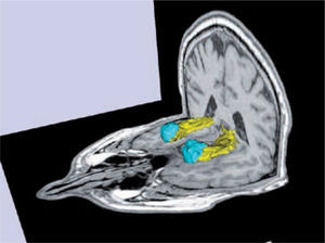 Volumetría y segmentación de los hipocampos (amarillo) y las amígdalas (celeste) de un sujeto normal. Software Freesurfer (http://ftp.nmr.mgh.harvard.edu/).