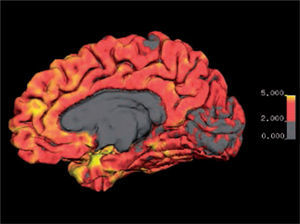 Imagen de espesor cortical de la cara medial del hemisferio derecho. Se visualiza espesor cortical mediante codificación por color entre los 0 y 5 mm. El espesor normal se encuentra entre los 2 y 5 mm., excepto en los lóbulos occipitales mediales en que el espesor puede ser menor a 2 mm. Software Freesurfer (http://ftp.nmr.mgh.harvard.edu/).