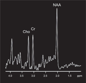 Espectroscopia cerebral normal. Se visualiza picos normales de N-acetil aspartato (NAA) que es un marcador neuronal, Colina (Cho) que corresponde a un marcador de sustancia blanca y la Creatina (Cr) el cual es un componente del metabolismo basal.