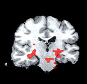 Resonancia magnética funcional de memoria en un paciente con esclerosis temporal mesial izquierda. Se muestra activación de los hipocampos durante una prueba de memoria visual.