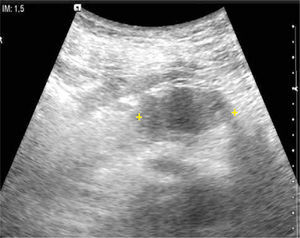 Cáncer de cuerpo pancreático. Imagen axial de ultrasonido a nivel de páncreas en paciente que se realiza chequeo médico. Se identifica una masa hipoecogénica que resalta sobre el parénquima hiperecogénico.