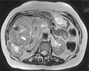 Sarcoma retroperitoneal. Secuencia T2 axial de RM. Gran masa retroperineal con desplazamiento de la vena cava inferior hacia anterior y del riñón derecho hacia lateral.