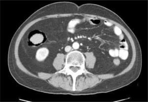 Enfermedad de injerto contra huésped. Corte axial de TC. Paciente con antecedente de trasplante de médula ósea, ingresa por diarrea. Se observa neumatosis de la pared del colon ascendente.