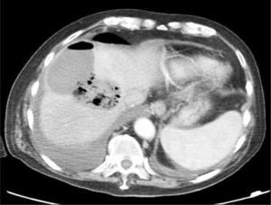 Absceso hepático post radiofrecuencia de hepatocarcinoma. Corte axial de TC muestra colección compatible con absceso en domo hepático.
