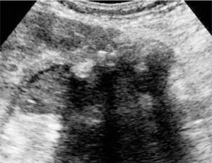 Cáncer de vesícula. Imagen obtenida en eje longitudinal de la vesícula biliar en paciente con dolor abdominal y baja de peso. Se observa una masa que envuelve cálculos biliares y se extiende al parénquima hepático adyacente.