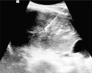 Biopsia de masa hepática guiada por ultrasonido. Se realiza biopsia en tiempo real de una masa hepática que dió como resultado un colangiocarcinoma, en paciente de sexo femenino de 32 años.