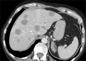 Metástasis hepáticas de cáncer de colon. Paciente de sexo masculino de 65 años con una neoplasia de colon se realiza TC de etapificación, que muestra múltiples metástasis hepáticas.