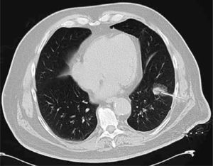 Punción biopsia de nódulo pulmonar bajo TC en paciente fumador de 62 años, con antecedente previo de cáncer renal. El resultado dió metástasis de hipernefroma. No se registraron complicaciones.