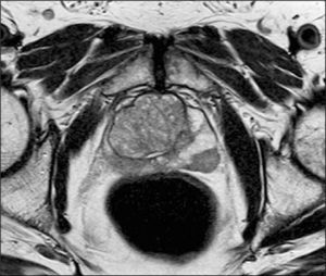 Cáncer de próstata. Secuencia T2 axial de alta resolución a nivel de la próstata, en paciente con APE alto y biopsias negativas. Se observa un nódulo hipointenso en la zona periférica lateral izquierda que fue biopsiado dirigidamente y dió como resultado adenocarcinoma.