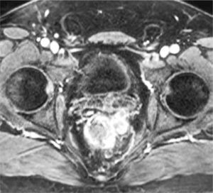 Cáncer de recto. Secuencia T1 postcontraste axial de RM. Se observa engrosamiento de la pared izquierda del recto con extensión a la grasa mesorrectal (compromiso T3), por lo que el paciente debe ir a quimio y radioterapia neoadyuvante previo a la cirugía.