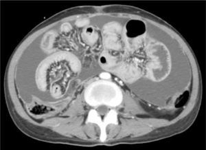 Obstrucción parcial de intestino delgado secundario a carcinomatosis peritoneal. Corte axial de TC. Engrosamiento peritoneal asociado a ascitis y dilatación de asa de intestino delgado.