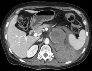 Metástasis suprarrenal izquierda hemorrágica. Corte axial de TC. Se identifica una masa suprarrenal izquierda que presenta hemorragia hacia posterior en paciente con antecedente de cáncer pulmonar.