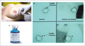 Identificación del linfonodo centinela A: inyección de azul patente, B: Linfocintigrafía, C: Azul patente.
