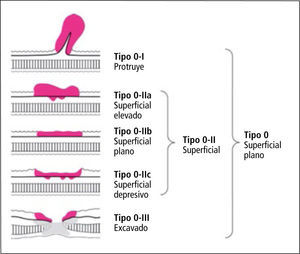 Clasificación macroscópica del cáncer gástrico incipiente