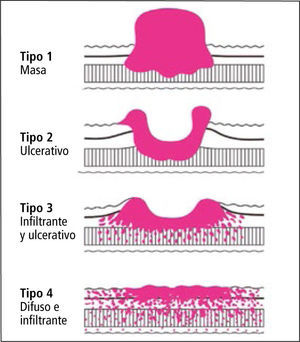 Clasificación macroscópica del cáncer gástrico avanzado