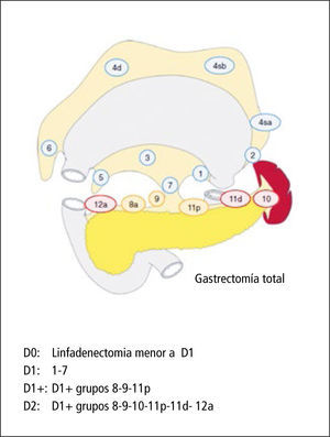 Definición de disección linfática para gastrectomía total en cáncer gástrico avanzado