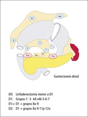 Definición de disección linfática para gastrectomía subtotal en cáncer gástrico avanzado