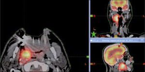 Volumen blanco, cáncer de base de la lengua definido por PET/CT.