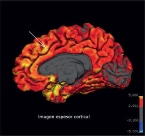 Imagen de grosor cortical (FreeSurfer, Martinos Center for Biomedical Imaging, v4.5.0). La corteza normalmente tiene un espesor menor de 5 mm. Nótese a derecha, en la región frontal, que la zona medial anterior tiene valores altos de espesor, debido a pseudo-engrosamiento cortical.