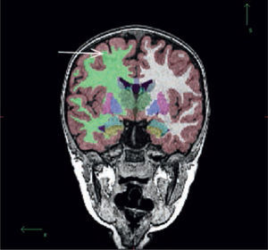 Paciente con displasia cortical. Imagen coronal potenciada en T1 de alta resolución, segmentada. (FreeSurfer, Martinos Center for Biomedical Imaging, v4.5.0). Pseudo adelgazamiento focal de la corteza frontal, secundario a la falta de diferenciación entre la corteza y la sustancia blanca (flecha).