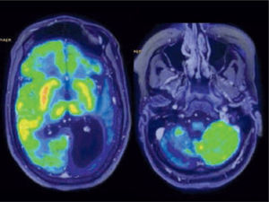 Imágenes de fusión de PET y RM en paciente con epilepsia. A la Izquierda: marcada alteración metabólica de hemisferio cerebral izquierdo en correspondencia con atrofia y dilatación ventricular. A la derecha: hipometabolismo severo de hemisferio cerebeloso contralateral.