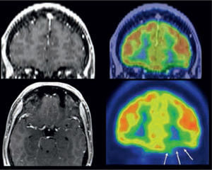A la izquierda: RM normal (secuencia T1 con gadolinio). A la derecha: Hipometabolismo frontal basal izquierdo (flechas). Una concordancia clínicoeléctrica apoya la cirugía aún con RM normal.
