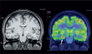 A la izquierda: RM en secuencia T1 con leve alteración de señal en hipocampo derecho. A la derecha: PET “ictal” realizado en paciente con frecuentes crisis epilépticas que muestra foco hipermetabólico en hipocampo derecho, que fue resecado con resultado de displasia cortical tipo IIB. Sin crisis a los 3 años de seguimiento.