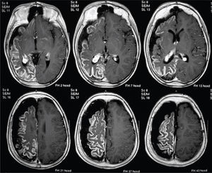 Niño portador de epilepsia refractaria con crisis de clínica frontal de área motora suplementaria y hemiparesia izquierda. RM de cerebro, corte axial en ponderación T1, con contraste (Gadolinio), muestra un Síndrome de Sturge Weber de hemisferio cerebral derecho. Se ve captación anormal del contraste en toda la corteza hemisférica derecha, así como atrofia de todo el hemisferio. Este caso fue evaluado en el año 2005 en otra institución y “se desechó alternativa quirúrgica por presentar EEG, con actividad ictal contra-lateral”. Post-publicación de Wyllie (Ref. 31) el niño fue evaluado en nuestra institución y pese a persistir los mismo hallazgos, se realizó una hemisferectomía funcional en el año 2011, permaneciendo libre de crisis hasta la fecha.