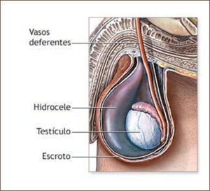 Hidrocele