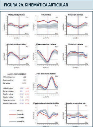 Destaca en color azul valores lado derecho y en rojo el izquierdo. Ciclo de marcha representado en función del tiempo del 0 a 100%. Línea vertical ubicada alrededor del 60% representa momento del despegue del pie, dividiendo las fases de apoyo y balanceo. Franja en achurado gris representa rango de valores de normalidad. Examen correspondiente a paciente portador de idiopatic toe walking.