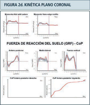 Destaca en color azul valores lado derecho y en rojo el izquierdo. Ciclo de marcha representado en función del tiempo del 0 a 100%. Línea vertical ubicada alrededor del 60% representa momento del despegue del pie, dividiendo las fases de apoyo y balanceo. Franja en achurado gris representa rango de valores de normalidad. Examen correspondiente a paciente portador de idiopatic toe walking.