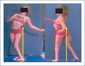 Mielomeningocele Mecanismos compensatorios en los planos sagital y coronal. La inclinación lateral del tronco permite compensar la insuficiencia de abductores de caderas, logrando estabilización excéntrica con los aductores. La inclinación posterior del tronco permite compensar la insuficiencia de extensores de caderas mediante estabilización excéntrica de flexores y estructuras capsulares anteriores de la cadera. Vector color amarillo representa a la fuerza de reacción al piso, mientras que el vector rojo representa el momento interno.