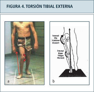 Figura 4a. Desviación lateral del vector de fuerza de reacción al piso, generando stress sobre estructuras mediales de la rodilla. El vector mal dirigido impide a la vez la adecuada extensión de la rodilla durante la fase de apoyo. Comparar con individuo normal, fgura 4b. Figura 4b: Vector de reacción al piso normal en la fase de apoyo monopodal, en posición medial al centro articular de la cadera y rodilla.