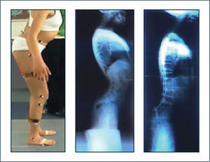 Enfermedad neuromuscular Se muestra fenómeno de “stooping” o inclinación anterior mantenida del tronco, debido al bloqueo de la compensación mediante hiperextensión del tronco para mantener el tronco erguido sobre una pelvis muy antevertida por insufciencia de extensores de caderas. Se observa el resultado al bloquear el mecanismo descrito mediante artrodesis de columna. La inclinación anterior mantenida del tronco determina agazapamiento en la marcha.
