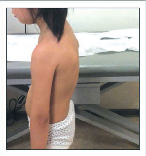 Alteraciones posturales Se observa hábito “asténico” con aumento de la xifosis torácica, rotación interna y aducción de hombros; pelvis en retroversión.