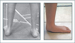Pie plano valgo Característico del síndrome de laxitud articular benigno. Destaca desviación en valgo del retropié y “desplome” del mediopié. El mal apoyo del pie favorece el aumento de progresión externa del pie durante la marcha.