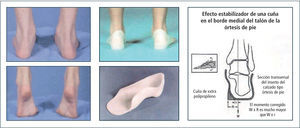 Fundamento biomecánico del efecto órtesis en pie plano laxo Reí 18.