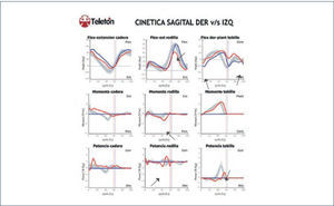 Kinética plano sagital Imágenes de kinemática y kinética articular en el plano sagital de caderas, rodillas y tobillos en paciente portador de SHAB. Aparecen representados kinemática, momentos y potencias articulares en función del ciclo de la marcha (0 a 100%). Línea vertical ubicada alrededor del 60% del ciclo de marcha representa el momento del despegue del pie, separando las fases de apoyo y balanceo. Lado derecho en azul e izquierdo en rojo. Franja achurado gris representa rango de normalidad para su grupo etáreo. Destacan alteraciones en ambos tobillos consistentes en flexión plantar anormal de tobillos en el balanceo final y contacto inicial. A nivel de rodilla izquierda destaca insuficiente flexión durante la fase de balanceo, mientras que durante la fase de apoyo si bien no se observa rango de hiperextensión, se asocia a momento flexor aumentado asociado a aumento de absorción de potencia que reflejaría tensión sobre estructuras posteriores de la rodilla.
