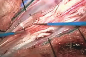 Microfotografía Intraoperatoria Que Muestra Raíz l4 Derecha y Gesto de Estimulación Eléctrica Con Ganchos-disectores de Microcirugía, Previo a Sección Foto tomada por los autores.