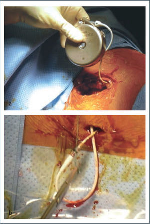 Técnica quirúrgica de implante de bomba de baclofeno. Arriba: bomba de baclofeno con catèter intratecal ya conectado, dispuesta a ser localizada en bolsillo subcutáneo abdominal. Abajo: Región lumbar. Catéter intratecal ya ubicado en espacio subaracnoideo a través de técnica percutánea guiada por radioscopía. La porción sobrante proximal será traccionada y enrollada bajo la bomba de baclofeno en el bolsillo subcutáneo, previo al cierre de las 2 incisiones quirúrgicas. Foto tomada por los autores.