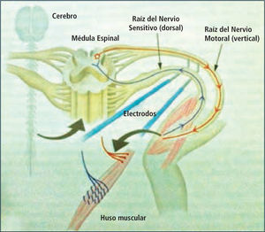 Arco Reflejo y Estimulación Eléctrica Radicular Gentileza Gentileza Gillette Children’s Specialty Helthcare.