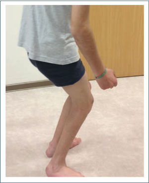 Marcha agazapada En la figura se observa un paciente con diplegia espástica que presenta una tripleflexión de sus extremidades inferiores o agazapamiento.