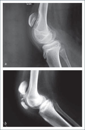 Falla extensión de rodilla a) En la figura superior se observa la rodilla de un paciente con sobre elongación del tendón rotuliano que genera una patela alta severa con depresión en el fémur distal. b) En la figura inferior se observa una fractura por estrés de la patela secundaria a co-contracción muscular entre agonistas y antagonistas en una rodilla de un paciente con parálisis cerebral.