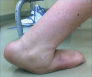 Pie equino plano valgo en pc En la figura inferior se observa un pié “quebrado” por una mala postura crónica del pie que subluxa o luxa articulaciones del medio pie y elonga estructuras capsulares y ligamentosas generando una palanca distal inapropiada.