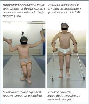 Evolución cirugía multinivel Imagen autorizada por el paciente y sus padres.