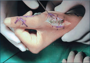 Detalles de cirugía sobre pulgar. Tenodesis del EPL a nivel de IF, y artrodesis de la articulación trapecio metacarpiana.