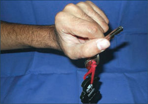 Con la extesnión de muñeca, el pulgar hace una pinza firma contra el índice, pinza llave.