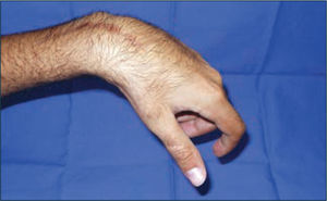 Con la relajación de la extensión de muñeca, ésta se flecta y el pulgar se separa del índice. Se sueltan los objetos.