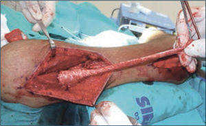 Detalle de la reconstrucción de la extensión de codo. El tendón tibial anterior es suturado al segmento posterior del deltoides.